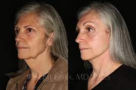 The Structural Face Lift