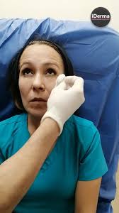 Rejuvenecimiento facial con Luz de Banda Ancha