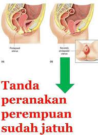 Namun pada dasarnya tujuannya hanyalah. Cara Kesan Peranakan Jatuh Masalah Peranakan Jatuh Adalah Sangat Membahaya Bagi Wanita Dan Peranakan Atau Rahim Boleh Jatuh Tanpa Anda Sedari Mungkin Normal Bagi Wanita Yang Pernah