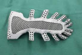 Woman With The Metal Chest Surgeons Implant World S First 3d Printed Titanium Sternum 3dprint Com The Voice Of 3d Printing Additive Manufacturing Metal Printing 3d Printed Metal Metal Chest
