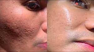 Hishh… nak kena tanya mak lah, mana tahu ada rahsia atau petua hilangkan bekas jerawat yang berkesan.. Kulit Berlubang Menjadi Flawless Dengan Rawatan Microneedling Di Prinz Giampapa Medisuite Youtube