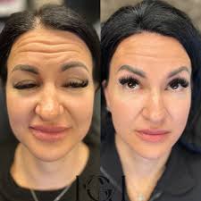 Highly Recommended Aesthetic Injector in Bryant, Arkansas