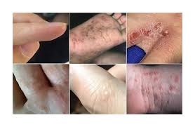 Image result for scabies transmission