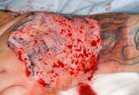 Effectiveness is low, and the possibility of scarring is extremely high. Do Tattoo Removal Creams Work