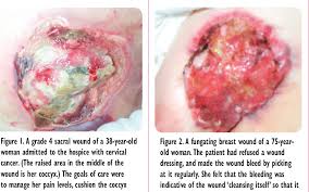 Prostate cancer is a common type of cancer in men, according to the mayo clinic. Figure 2 From Principles Of Skin And Wound Care The Palliative Approach Semantic Scholar