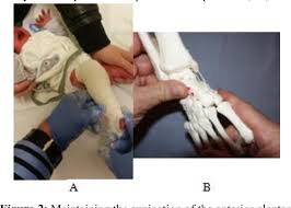 We did not find results for: Pdf Ponseti Method Some Measured Steps To The Success In Idiopathic Congenital Clubfoot Management Semantic Scholar