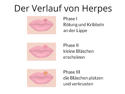 Lippenherpes Wie Kommt Es Dazu Und Wie Wird Behandelt