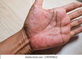 Rash On Palms Images Stock Photos Vectors Shutterstock