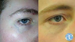 They are frequently discovered on the lower section of the eyelid and. You Re So Vein Absolute Aesthetics