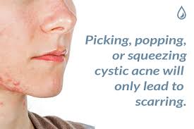 For more advice on how to get rid of pimples fast, don't miss: I Always Get Cystic Acne Around My Jaw Neck And Ears How Do They Form The Dermatology Specialists