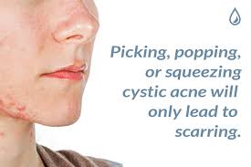 What other skin conditions can mimic acne symptoms and signs? I Always Get Cystic Acne Around My Jaw Neck And Ears How Do They Form The Dermatology Specialists