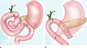 Pancreatoduodenectomy Whipple Procedure Drawings Show That The Download Scientific Diagram