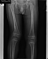 Keep it 100 lets act on this police. Limping For Two Months What Is The Most Likely Diagnosis