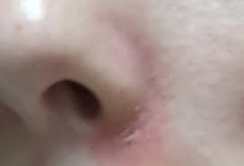 Skin Issue Around Nose So Lately I Ve Been Having An Nras