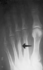 The metatarsals were the most common bone type involved with the third metatarsal a mean rehabilitation time for single metatarsal fractures was found to be 12.2 weeks, which still being a period of rest from training sufficiently long enough so as to allow healing to occur. Stress Fracture In Foot Metatarsal Stress Fracture
