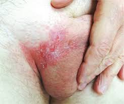 Image result for sore skin in the groin area