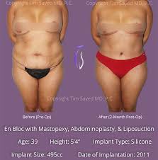 Image result for Liposuction