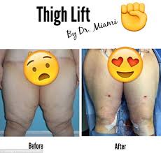 How much is a bbl with dr miami. Dr Miami Michael Salzhauer Shares Graphic Before And After Plastic Surgery Photos Daily Mail Online