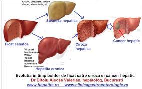 Uleiul, boabele de porumb sau mămăliga duc la ameliorarea sau chiar la vindecarea cardiopatiei ischemice şi a psoriazisului. Ficatul Se Regenereaza Cabinet De Gastroenterologie Si Hepatologie Bucuresti 0758 751 841
