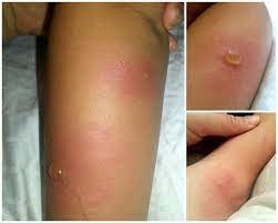 Skeeter syndrome (papular urticaria) is a localized allergic reaction to mosquito bites, consisting of inflammation and sometimes fever. Pin On Bug Bites