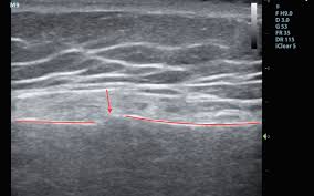 Image result for Sternal Fracture