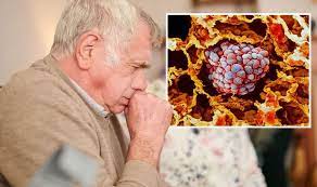 Maybe you would like to learn more about one of these? Lung Cancer Symptoms Signs Include Bronchitis Express Co Uk