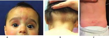 Image result for Nevus Simplex