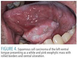 Image result for white cancer on tongue)