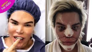 If you search the hashtags you'll see some extreme freaky immediate before and afters, especially from some russian accounts, that resemble more of an alien than natural beautiful eyes. The Human Ken Doll Undergoes Controversial Surgery To Look Like A Sexy Cat Mirror Online