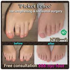 In recent years, lasers have shed their science fictional image to become a surgeon's and dermatologist's most promising weapon in the fight against aging skin. Realnycfootcare Feet Care Nyc Surgery