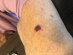 Image result for Skin Trauma