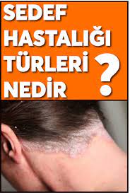 Sedef Hastaliginin Turleri Nelerdir Movie Posters Movies