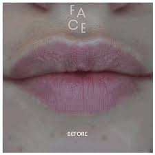 Video clip taken immediately after procedure lip augmentation in our birmingham clinic our client had 1ml lip fillers please text 07950409837 for. Hyaluronic Acid Gel Faq Oakland Ca Face