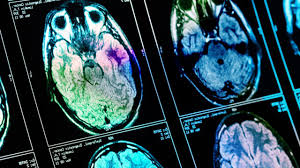 Prise en charge des avc : Victime D Un Avc Hemorragique A 28 Ans Margot Raconte Son Experience Voix Des Patients