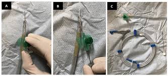 Image result for Urethral Catheterization