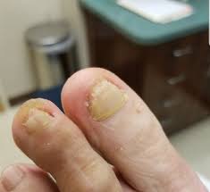 The infection may also cause cracking or ulcerate the skin exposing the underlying tissue. Achieving Significant Nail Clearing After 13 Years Of Failed Treatment For Thick Discolored Toenails Podiatry Today