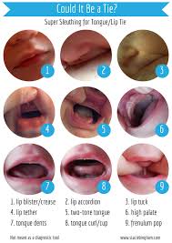 Could My Baby Have A Tongue Or Lip Tie Baby Tongue Tounge Tied Baby Blister On Lip