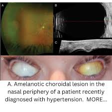 Image result for lesion sclera