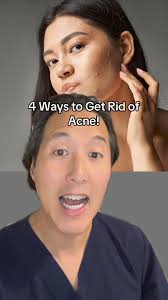 How to Get Rid of Acne! Learn a bunch more in my latest podcast!  https://podcasts.apple.com/us/podcast/the-doctor-youn-show/id1202449205