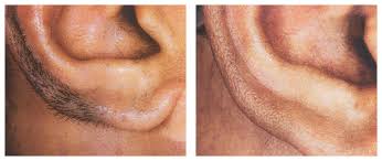 Whether you have hair on your face, legs, bikini line, or anywhere else on your body, laser hair removal is the only option for permanent hair removal. Laser Hair Removal Brampton Astra Medicare