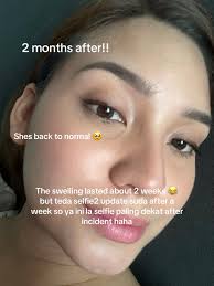 Half My Face Is Swollen