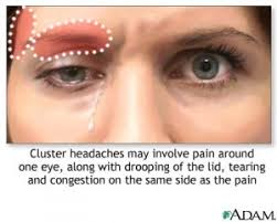 Apa Sih Cluster Headaches Sakit Kepala Cluster Itu Norma Web Id