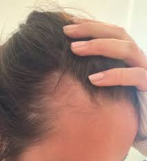 Does it really aggravate hair loss? Accutane Hair Loss Lawsuit