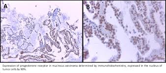 Cáncer de pulmón lung cancer. Mucinous Carcinoma Of The Breast A Case Report And Review Of The Literature Medwave