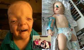 Boy Six Who Was Born Severely Disabled Has A Condition So Rare It Has Been Named After Him Daily Mail Online