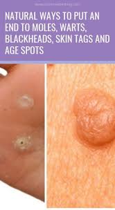 At Some Point Of Life We All Can Have Certain Skin Issues Like Moles Skin Tags Clogged Pores Or Skin Breakouts Natural Healing Remedies Remedies Herbalism
