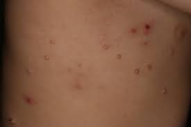 Molluscum contagiosum is treatable by freezing, creams. Molluscum Contagiosum Skin Disorders Msd Manual Consumer Version
