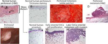 Ovarian Cancer Development And Metastasis The American Journal Of Pathology