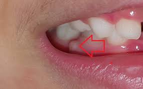 Pain relief measures a gum abscess is not always what it seems, as there may be underlying issues that need to be treated such as a weakened immune system. Tooth Abscess In Children Caused By Shoddy Dental Work In Singapore My2ks