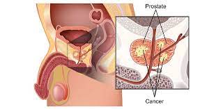 Kanker prostat merupakan keganasan yang disebabkan oleh tumbuhnya sel abnormal di bagian kelenjar prostat pria, kelenjar pada sistem reproduksi yang . Kanker Prostat Ahcc